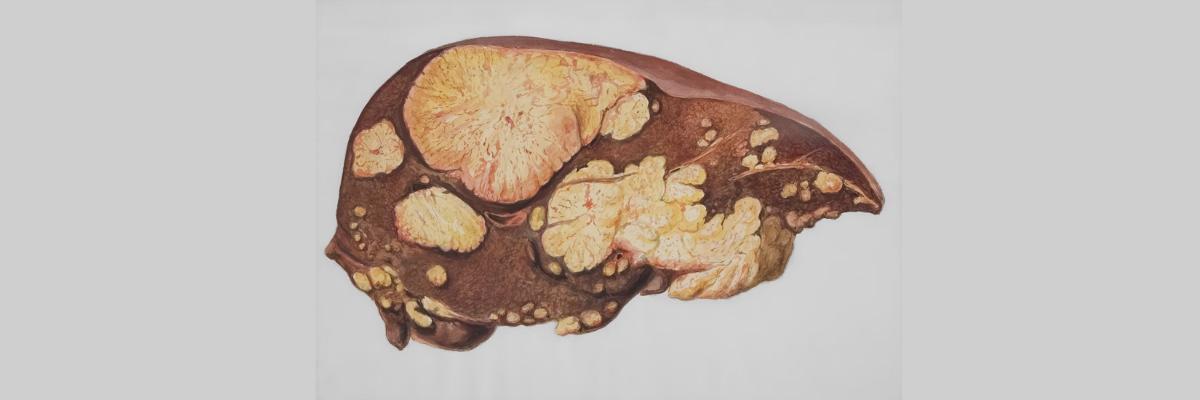 Western lifestyle stimulates the accumulation of fat in the liver - UNISINOS Institute Foundations -