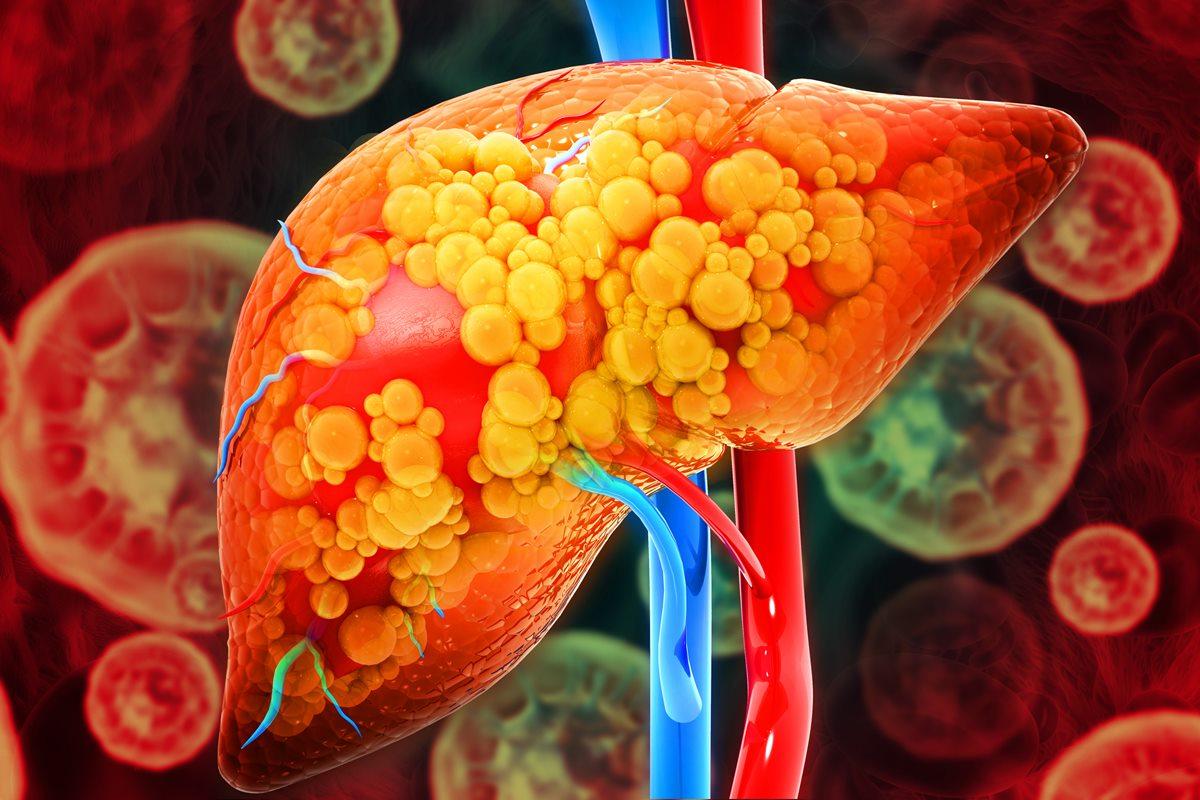 Fígado gorduroso: dicas simples para prevenir o fígado gorduroso